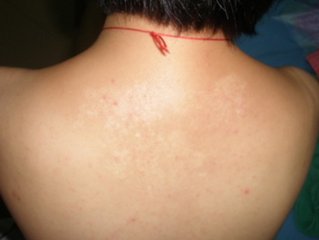 白癜风给不同人群带来哪些不同的伤害