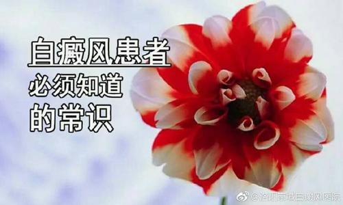 治疗白癜风的常规知识，你了解吗？