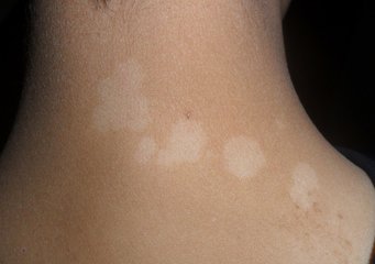 白癜风治愈后还需要注意什么 白癜风患者要如何护理