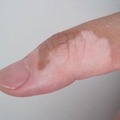 白癜风病情到了晚期重要危害有哪些