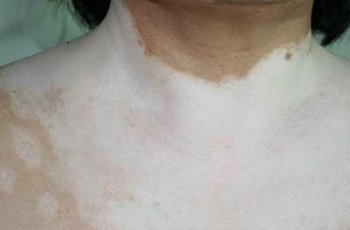 白癜风患者如何学会自我保护