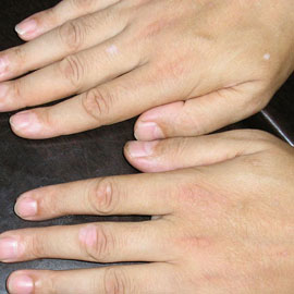 了解一下护理白癜风时需要注意哪些